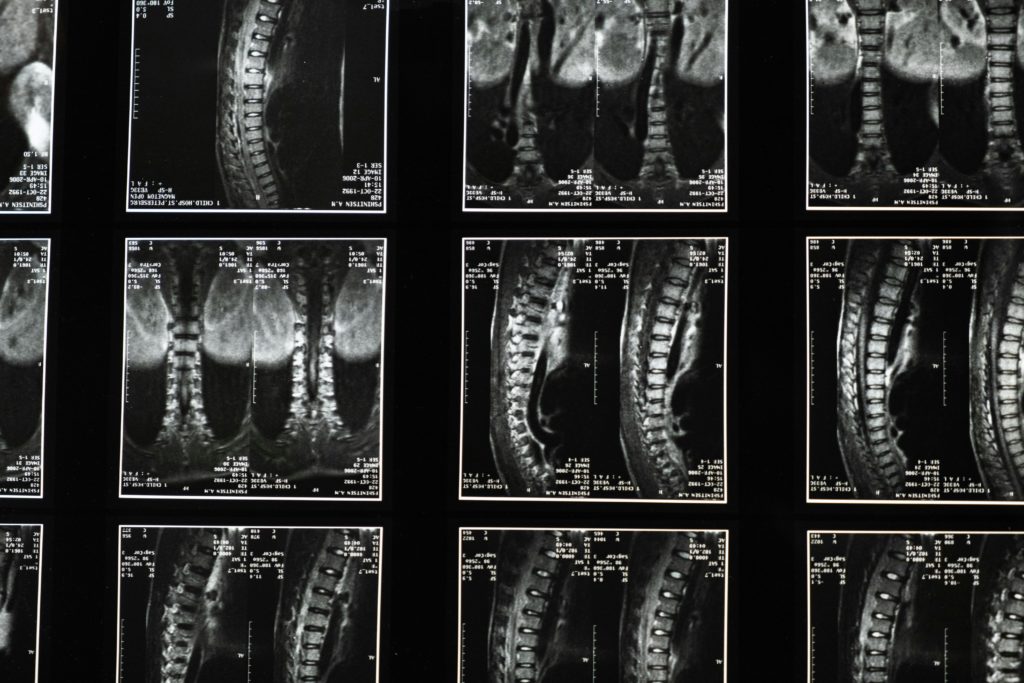 spinal hemangioma symptoms modern interior aesthetic professional photography.jpg