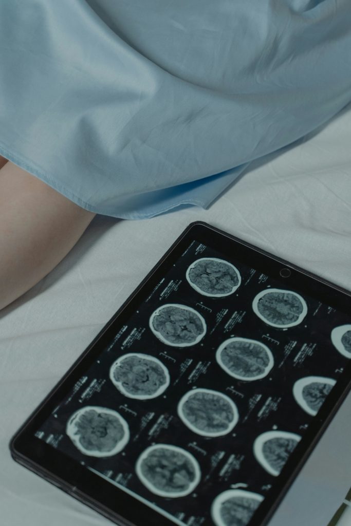 brain tumor glioblastoma modern professional photography.png